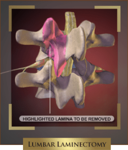 What Happens When You Have an Injury That Requires a Lumbar Laminectomy